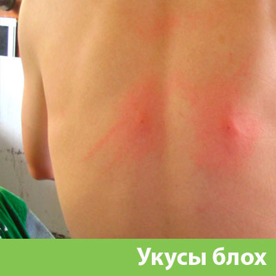 Укусы блох в Серове