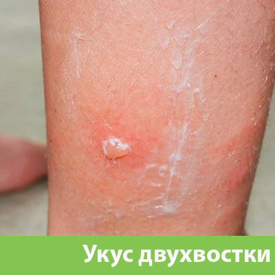 Укус двухвостки в Серове