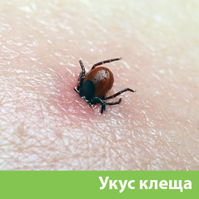 Укус клеща в Серове